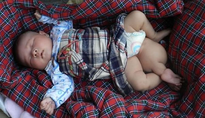 Three legged baby born in China